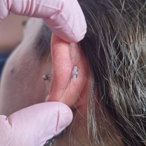Disco de silicona para tratamiento de granuloma: imagen 3