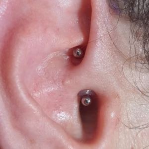 Disco de silicona para tratamiento de granuloma: imagen 2